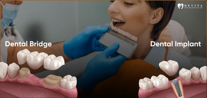 Dental Bridge vs Implant: Which Tooth Replacement Is Better?