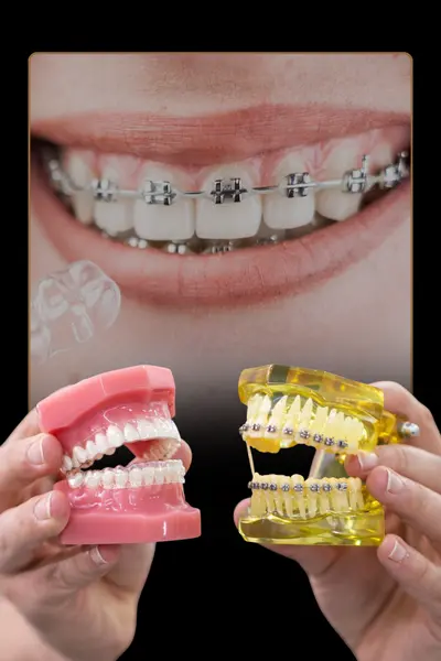Invisalign vs Braces: Which Is Better for You? 