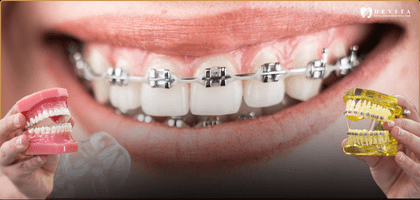 Invisalign vs Braces: Which Is Better for You? 
