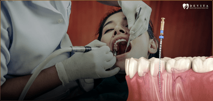 When Is Root Canal Treatment Necessary? Signs, Diagnosis & Modern Care 
