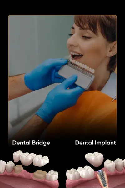 Dental Bridge vs Implant: Which Tooth Replacement Is Better?
