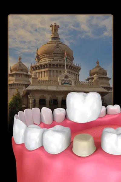 Dental Crown Cost in Bangalore: Types, Materials & Prices