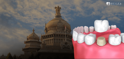 Dental Crown Cost in Bangalore: Types, Materials & Prices