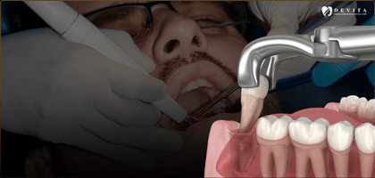 Wisdom Tooth Removal: When Is Extraction Really Necessary?