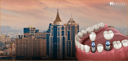 Dental Implant Cost in Bangalore: What You’ll Actually Pay in 2026 