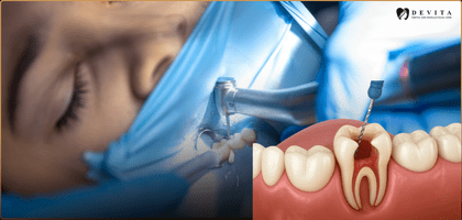 Is It Safe to Delay a Root Canal Treatment?  