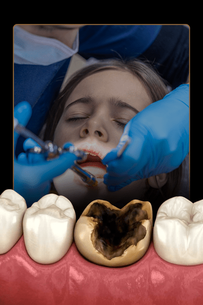 Teeth Decay
