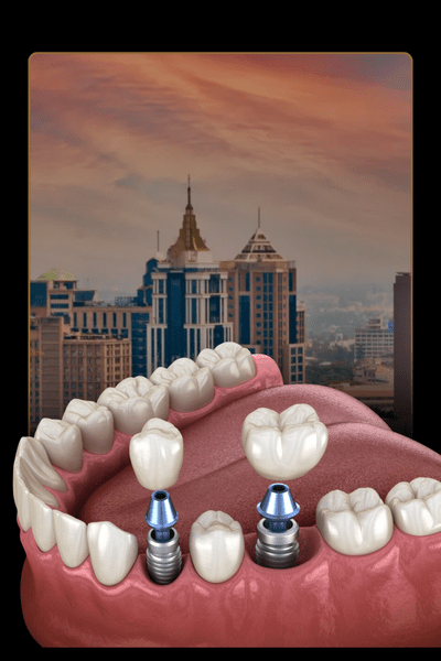 dental implents
