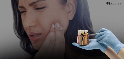 Painless Root Canal Treatment in Bangalore – What to Expect 