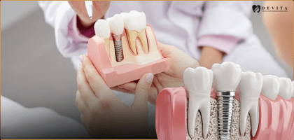 Single Tooth Implant Cost in Bangalore: What to Expect in 2026 