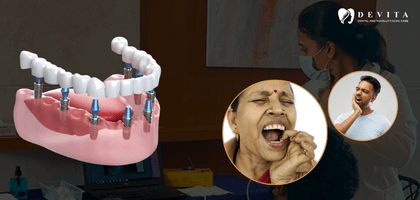 How Dental Implants Help Restore Your Smile, Bite and Jawbone Health 