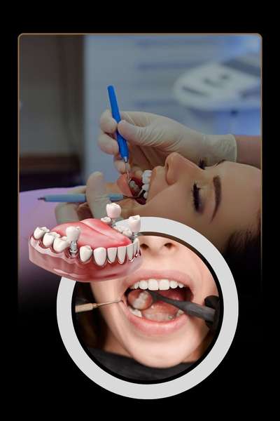 Dental implants in Bangalore restoring smile, bite and jawbone health
