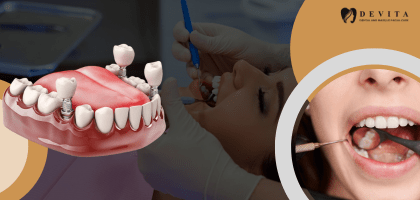 Can You Get a Dental Implant Immediately After Tooth Extraction? What You Need to Know 