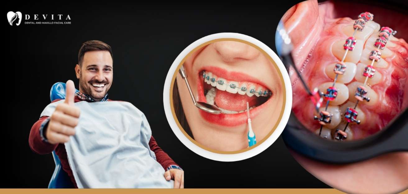 Braces Cost in Bangalore: Metal, Ceramic and Other Options Explained 