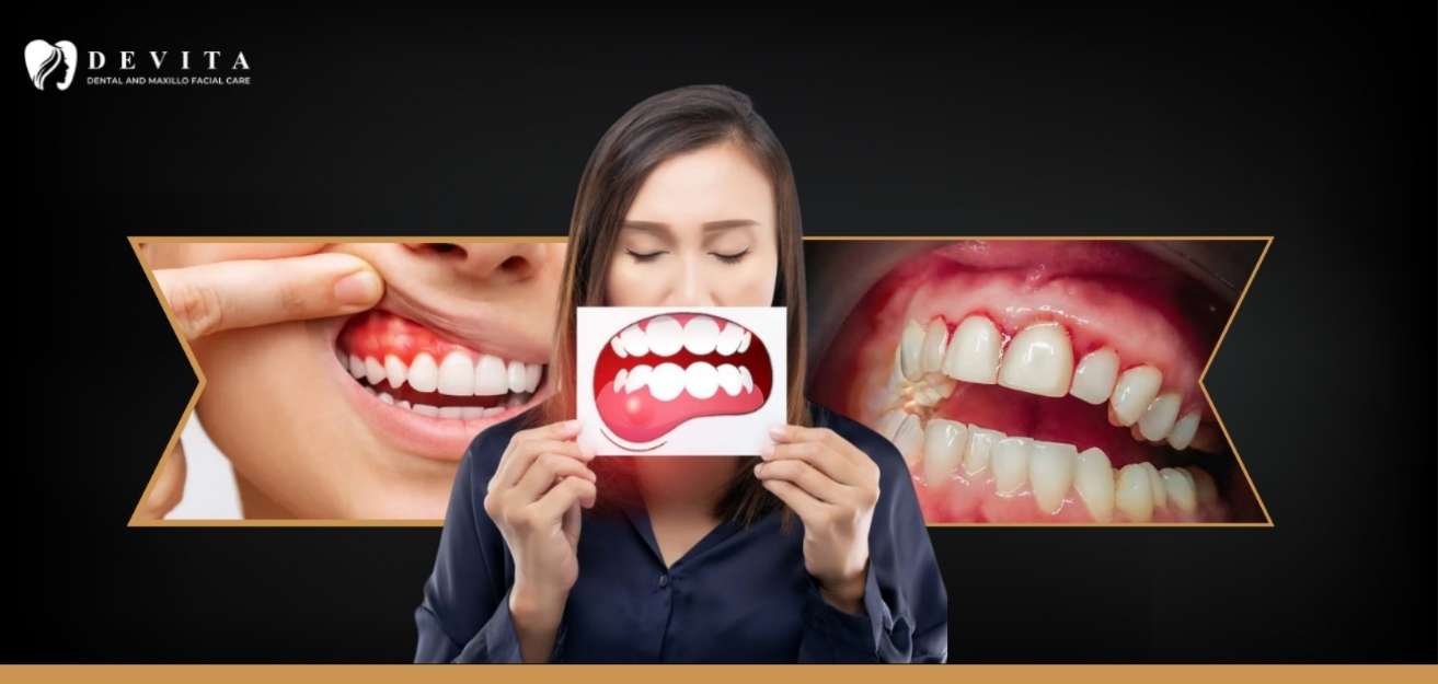 Gum Disease Treatment in Bangalore: Gingivitis, Periodontitis & Treatment Options 
